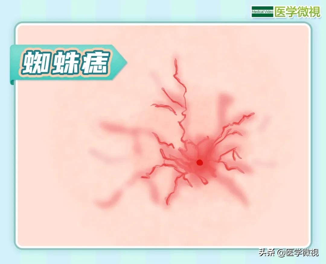 肝病的五大表现你中了几个,肝病早期九大征兆