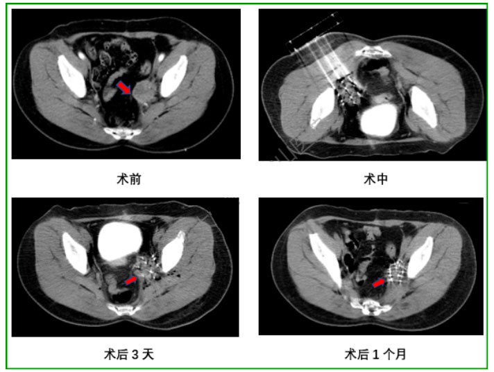 肿瘤治疗新方法----放射性粒子植入治疗
