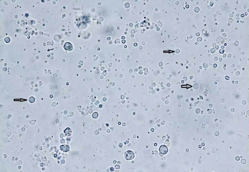 前列腺常规检查报告单正常,前列腺核磁共振报告单怎么解读