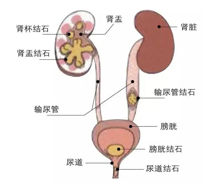 肾结石疼到怀疑人生的图片,肾结石科普一下