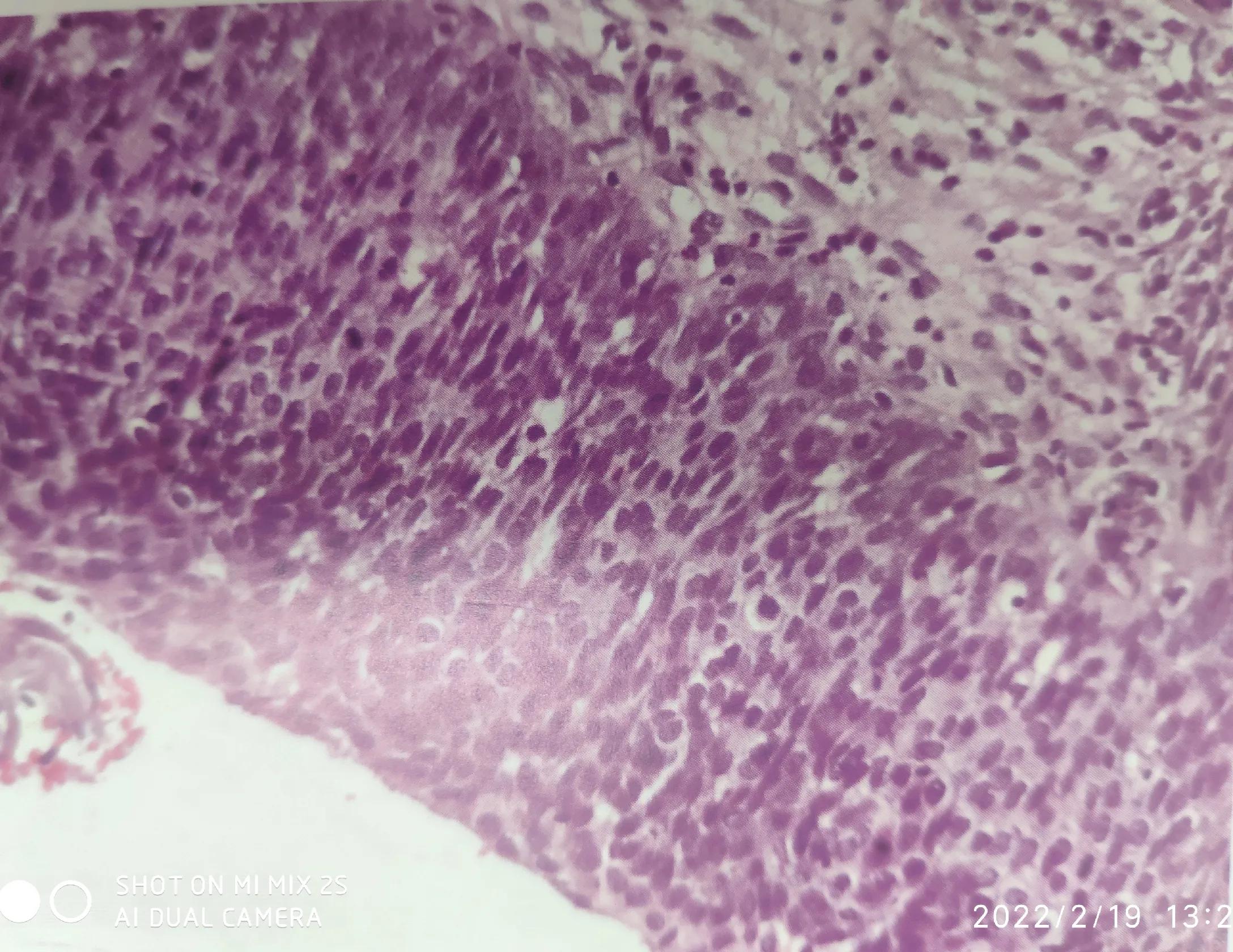 活检结果cin3有可能是宫颈癌吗,宫颈病理报告炎症会显示异常吗