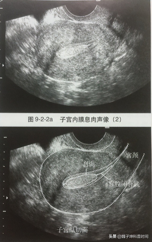 宫腔镜都能查出来什么,宫腔镜检查可以查到哪些病