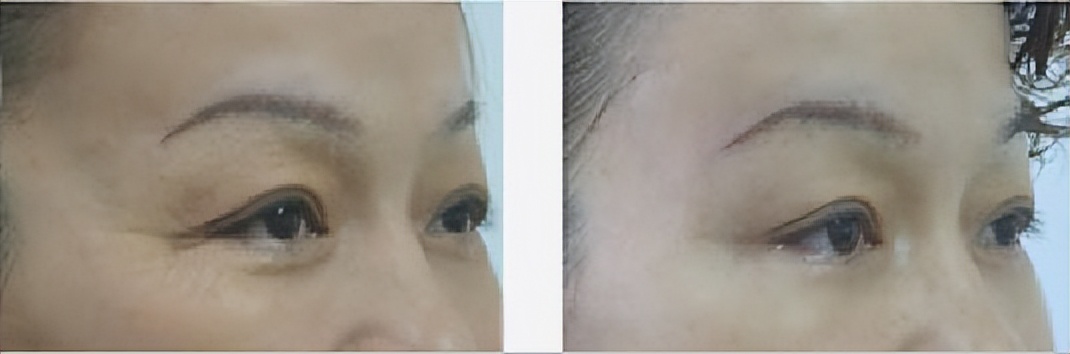 眼角下垂割双眼皮眼尾拉长,眼角上扬眼尾下垂怎么画眼线