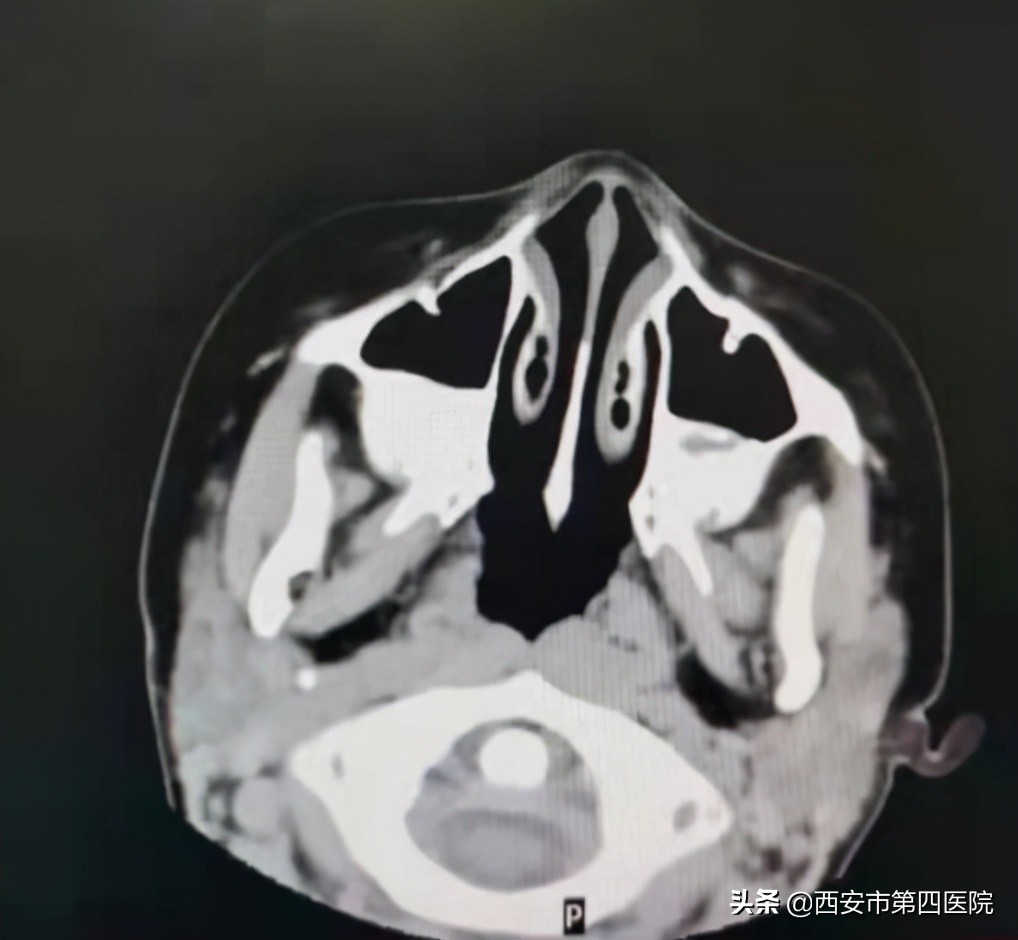 孩子反复咳嗽、鼻塞、流脓性鼻涕，以为是“感冒”？这都是鼻窦炎惹的祸！