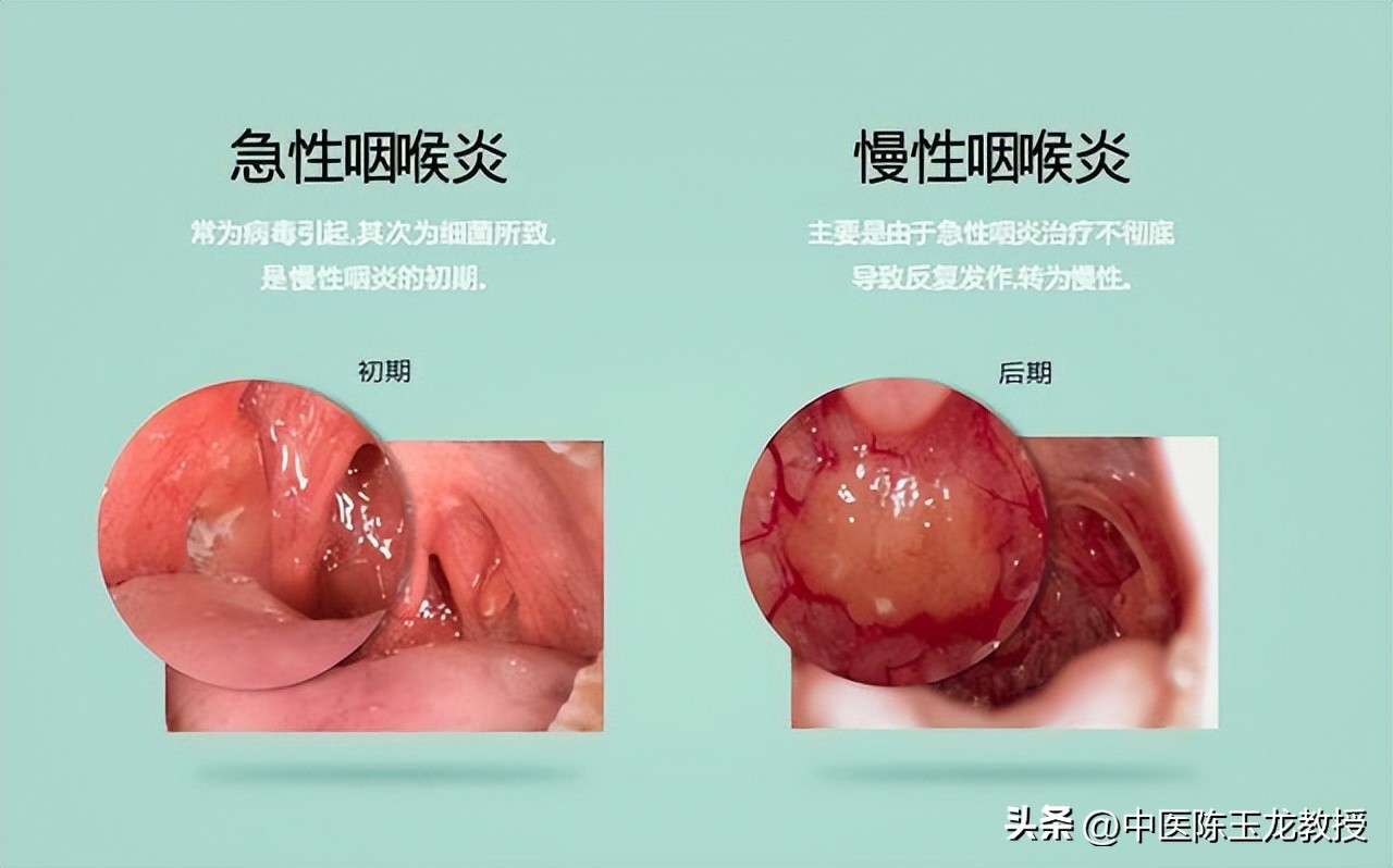 胆囊炎胆囊息肉胆结石中医偏方,胆囊炎胆结石胆囊息肉吃什么药好