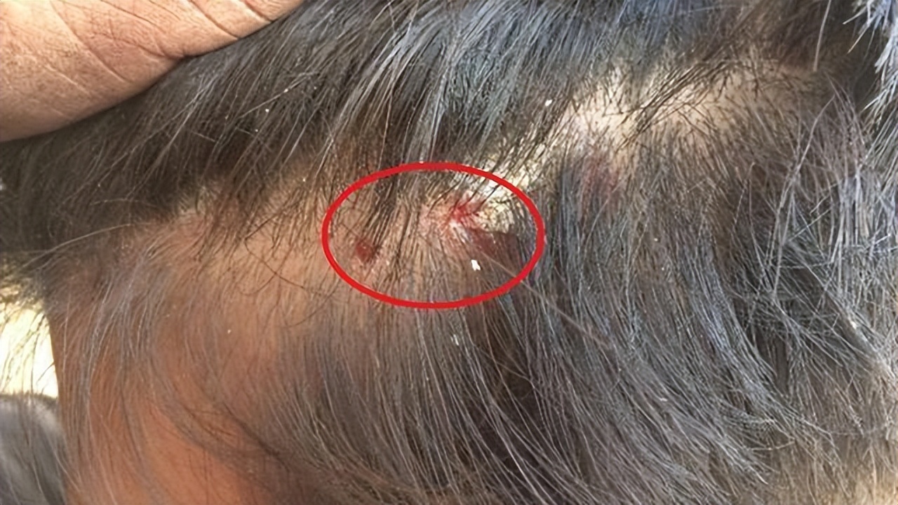 头皮总长疙瘩和脓包是怎么回事,头皮老是长疙瘩有脓包怎么办