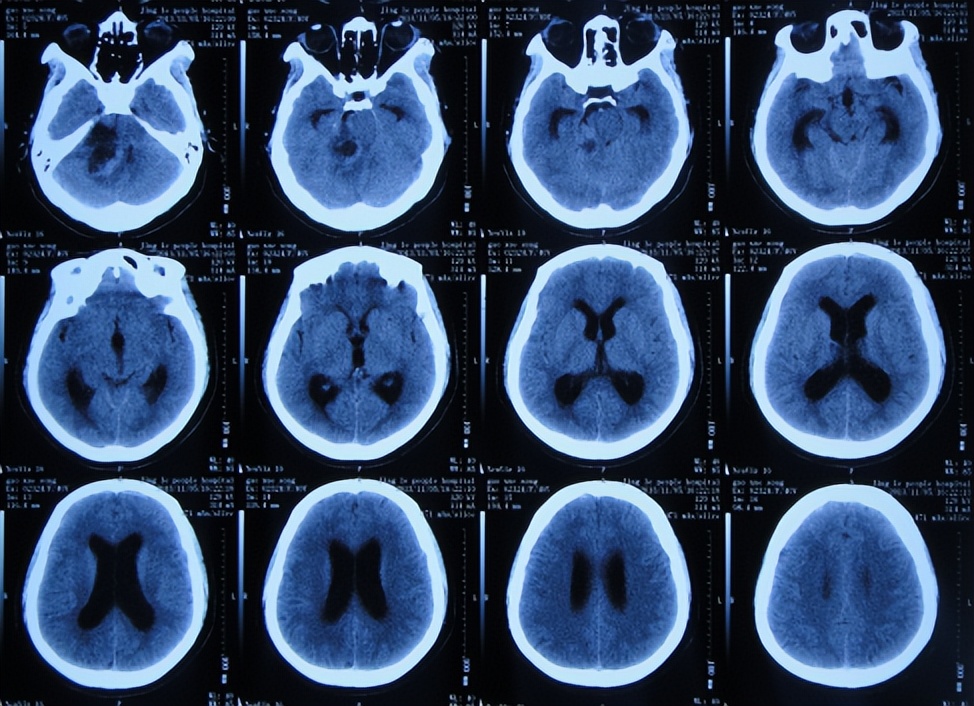 听神经瘤出现脑积水和出血,听神经瘤手术后颅压高症状