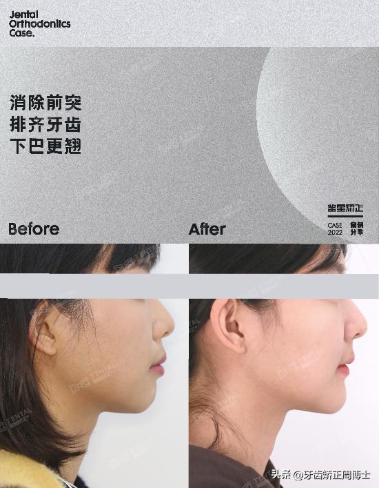 骨性龅牙矫正牙齿变小了,骨性龅牙已经做了正畸手术怎么办