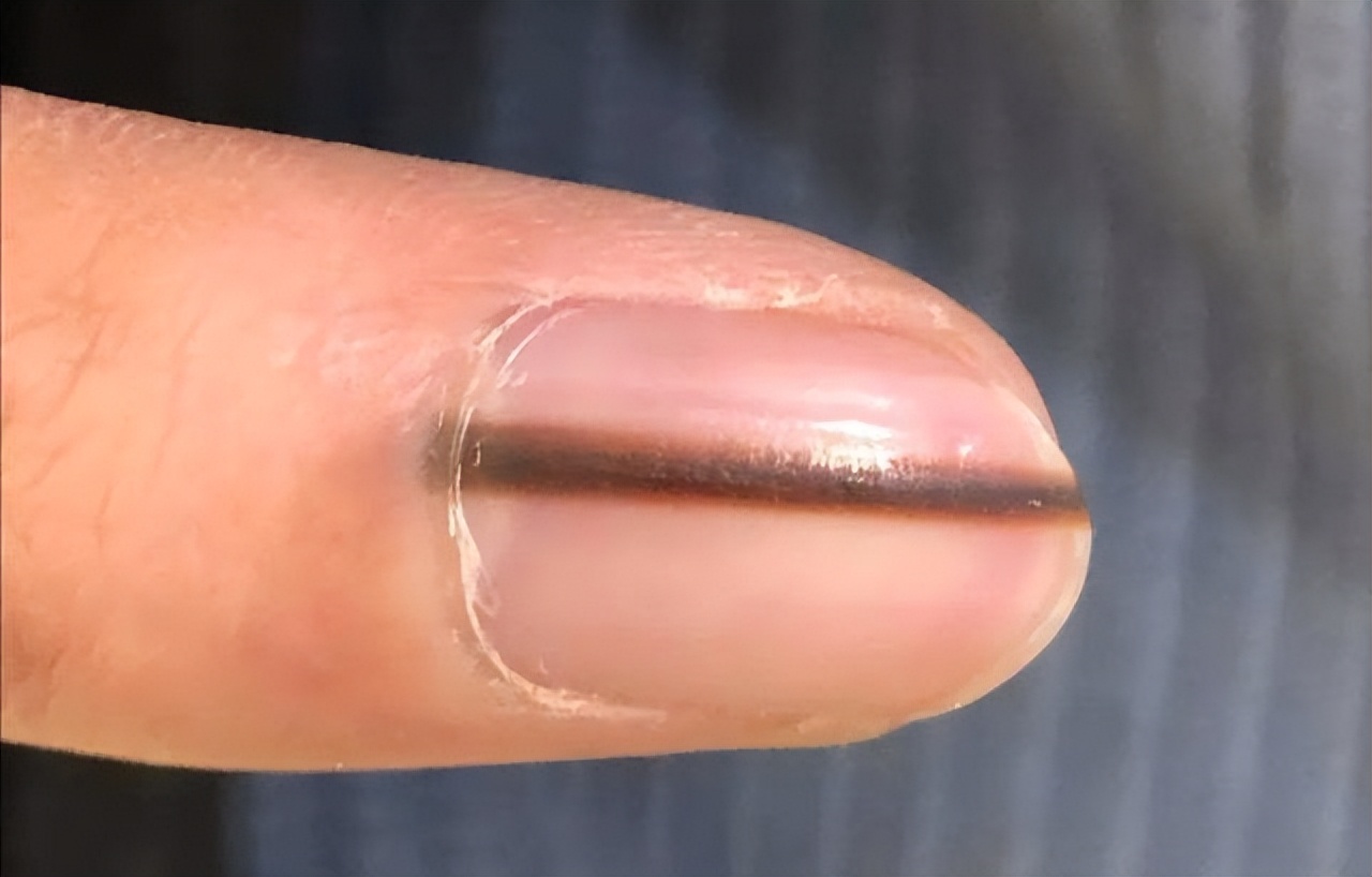 体内有癌皮肤先知提醒,体内有癌手部先知有三种表现