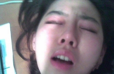 中暑后的最佳处理方法,中暑后怎么办最快解决方法