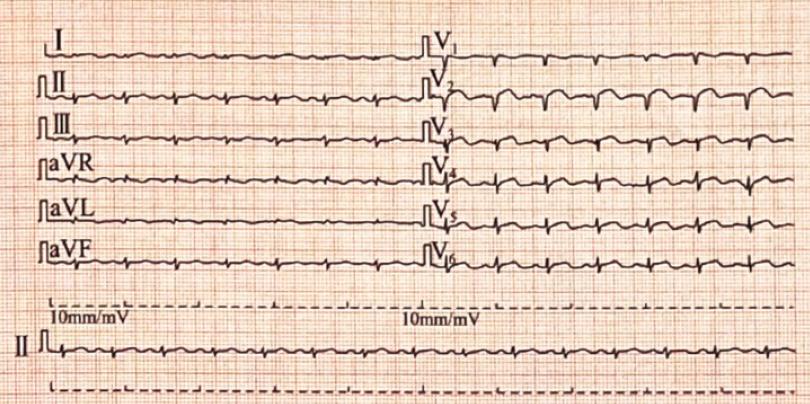 女患者发生扑朔迷离的“心肌梗死”,警惕心碎综合征!