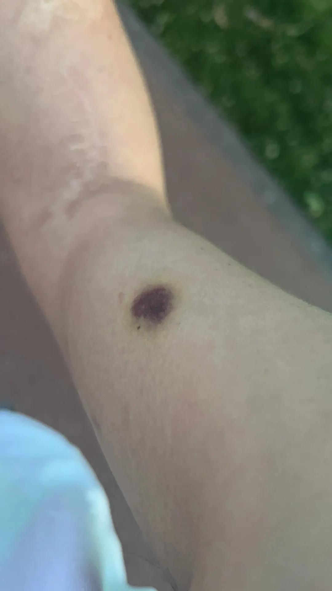 急性白血病的确诊依据,白血病m3的确诊方法