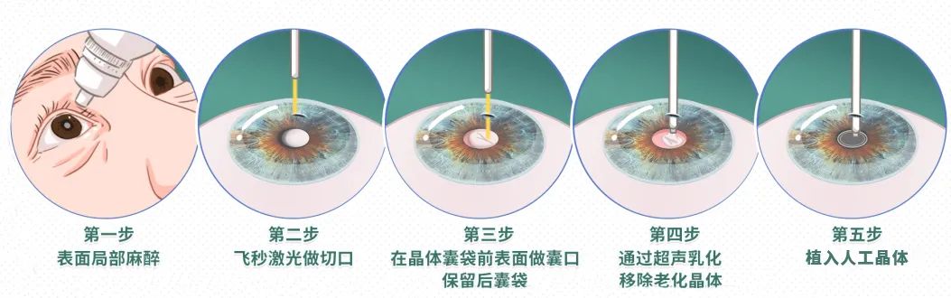 40多岁得了老花眼?!别慌!激光矫治让你“返老还童”