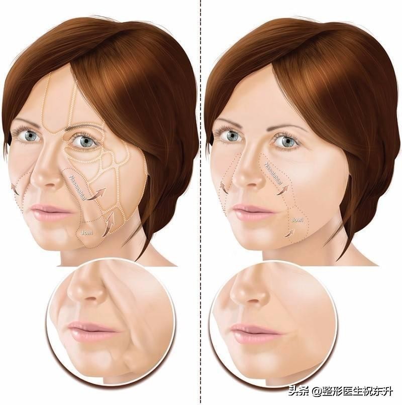 消除法令纹和嘴角纹最好的方法,法令纹怎么消除简单方法