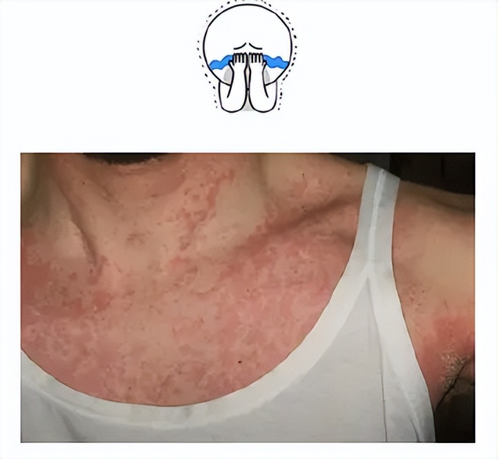 老年人经常过敏是什么原因,老年人经常过敏是怎么回事