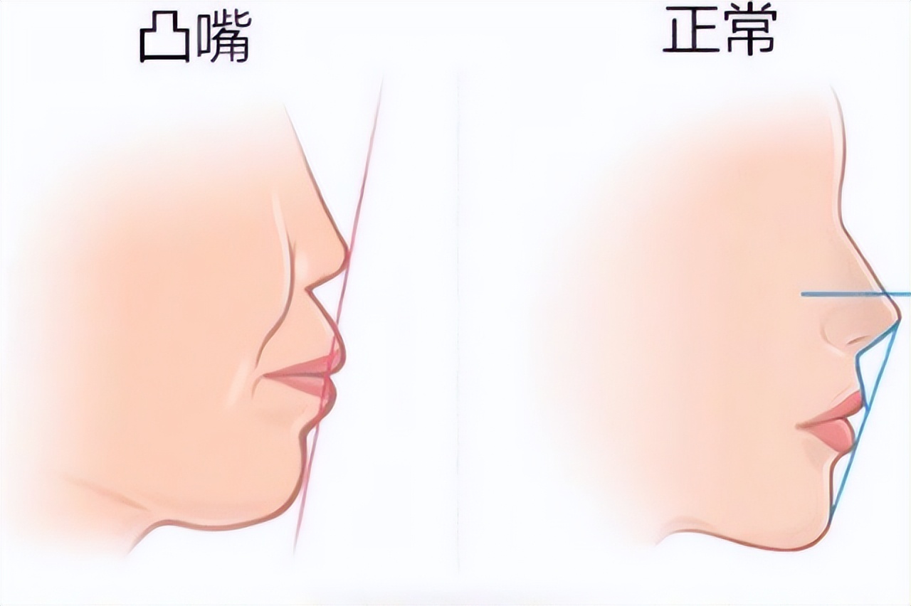 嘴突是什么导致的,嘴突是什么原因导致