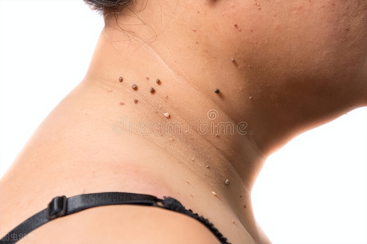 特别小的黑痣有可能是黑色素瘤吗,黑痣有可能变成黑色素瘤吗