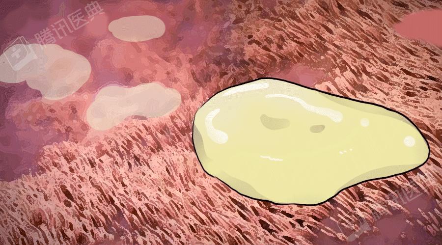 感冒鼻涕颜色的区别,感冒鼻涕的颜色区别