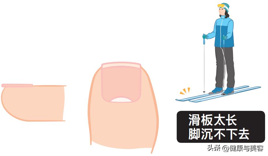 指甲卷曲内卷,指甲卷曲用什么药