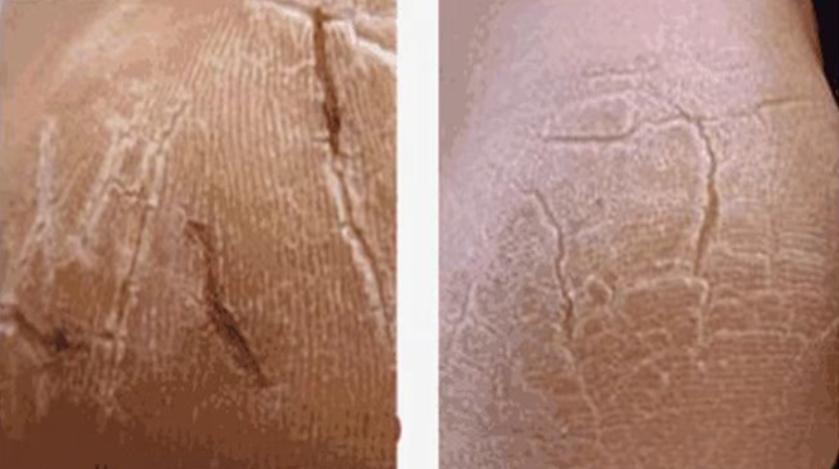 脚后跟干裂可能与这4个原因有关,脚后跟总干裂原来是这3个原因