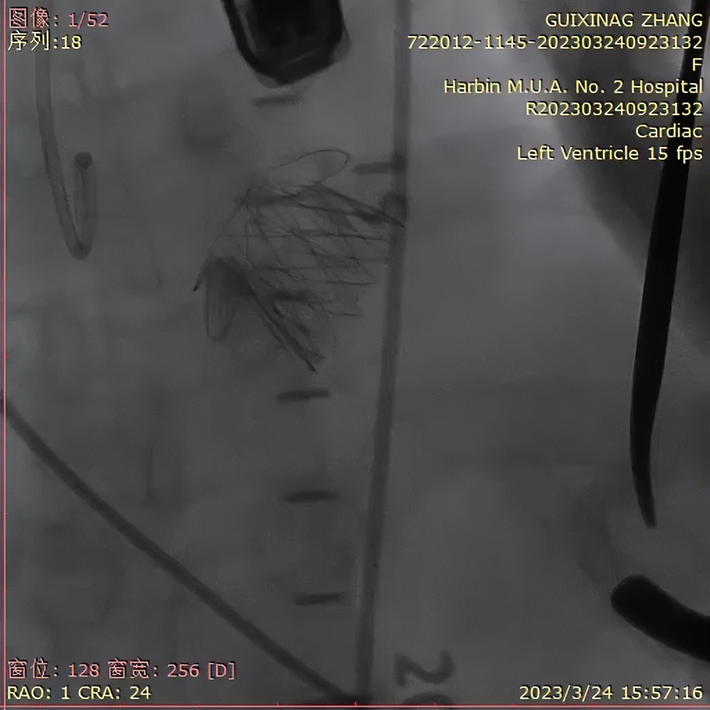 “小心尖、大作为”哈医大二院心外科微创治疗瓣膜疾病造福患者