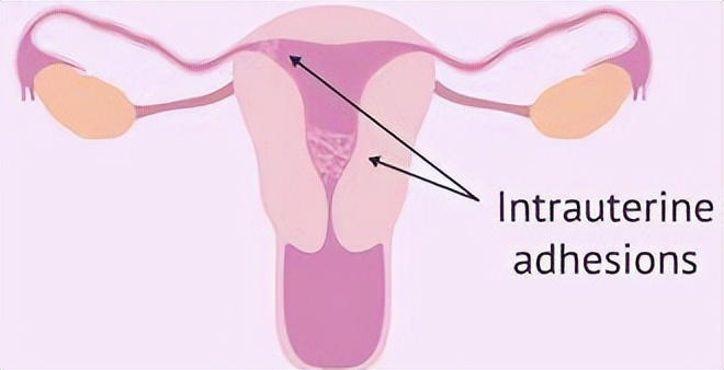 子宫内膜与妊娠,子宫内膜避孕器取出手术需要多久
