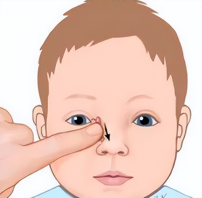 先天性泪道阻塞可以不做手术吗,先天性泪道堵塞按摩效果