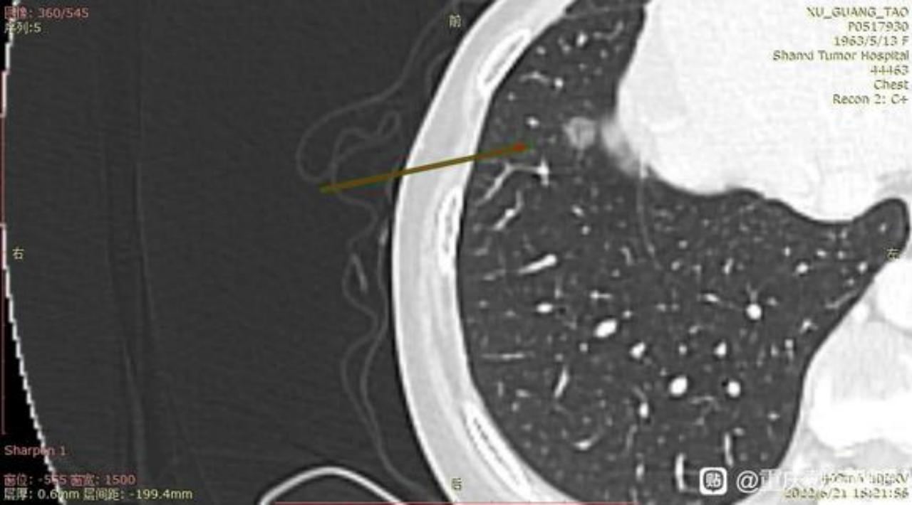 母亲腺癌,母亲确诊小细胞肺癌