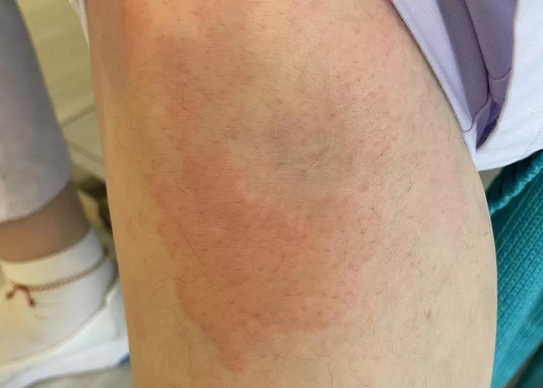 宝宝网红霜,用完宝宝霜长红疹了