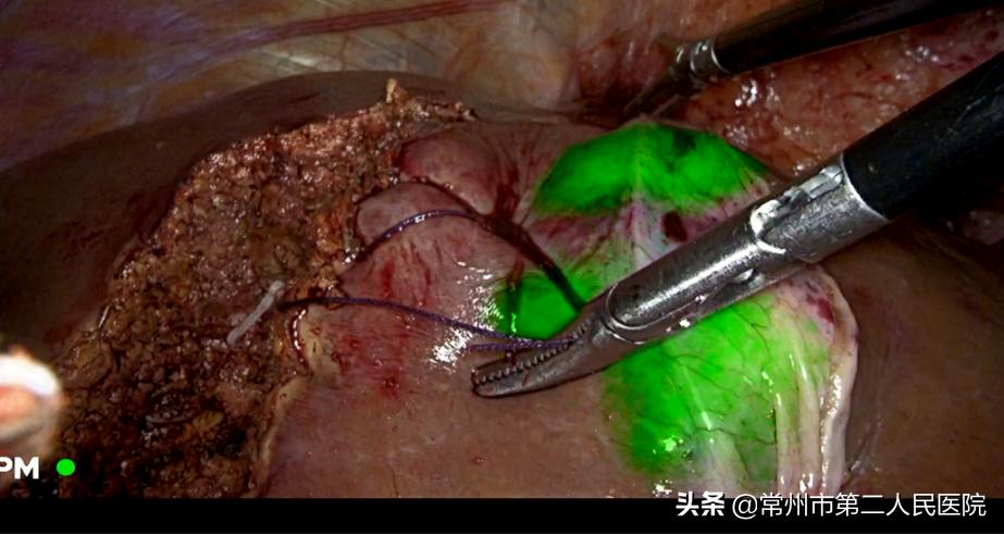 严重心脏病遇上肝肿瘤常州二院成功实施荧光腹腔镜下精准切除