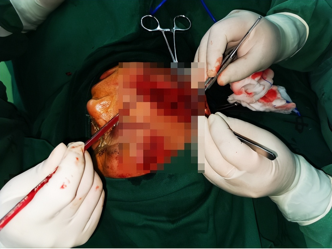 *安泰**市中心医院口腔颌面外科协同多学科成功救治一名突发事件重伤患者