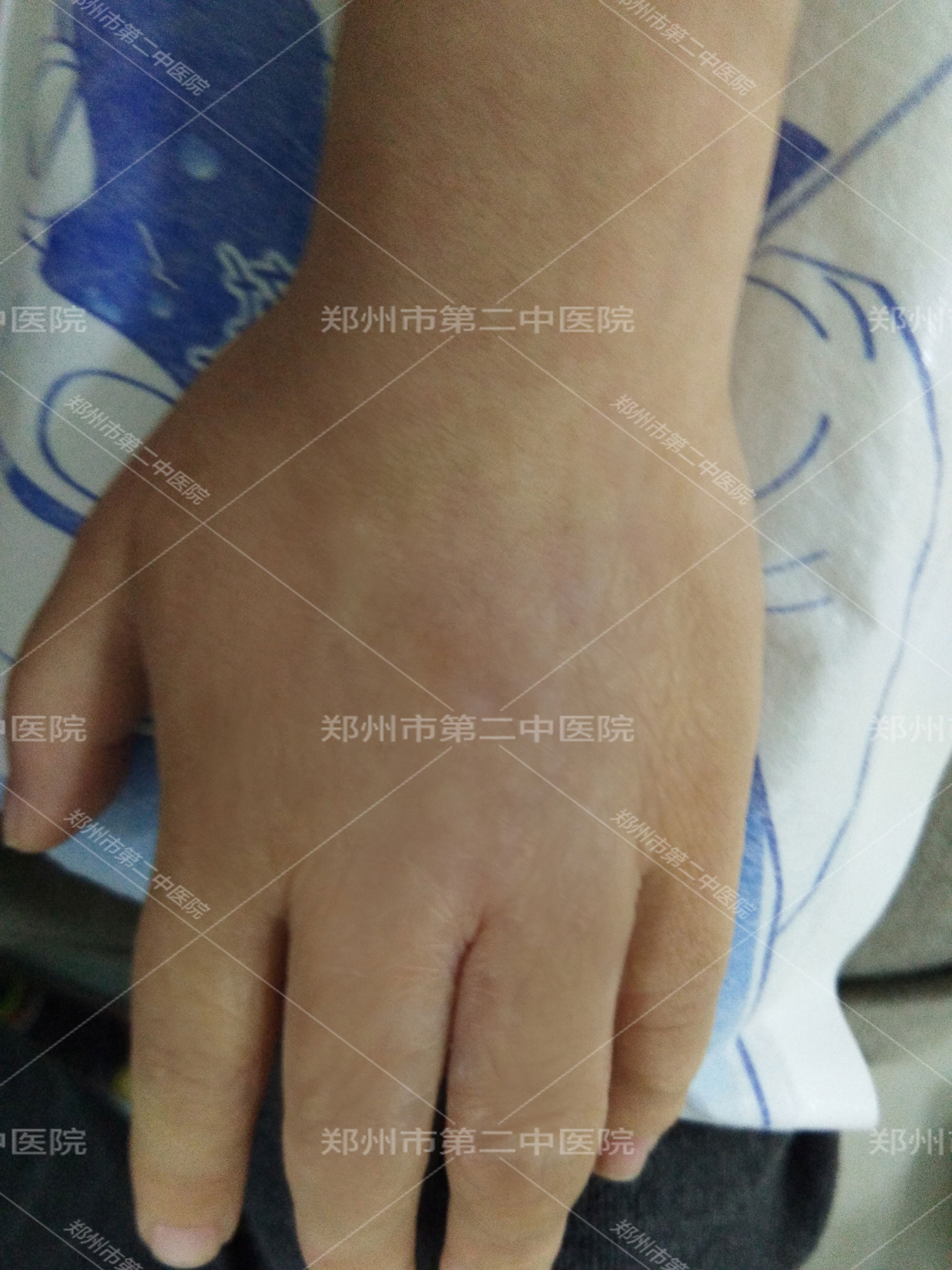 郑州市哪家治疗疤痕最好,郑州市第二中医院治疤痕