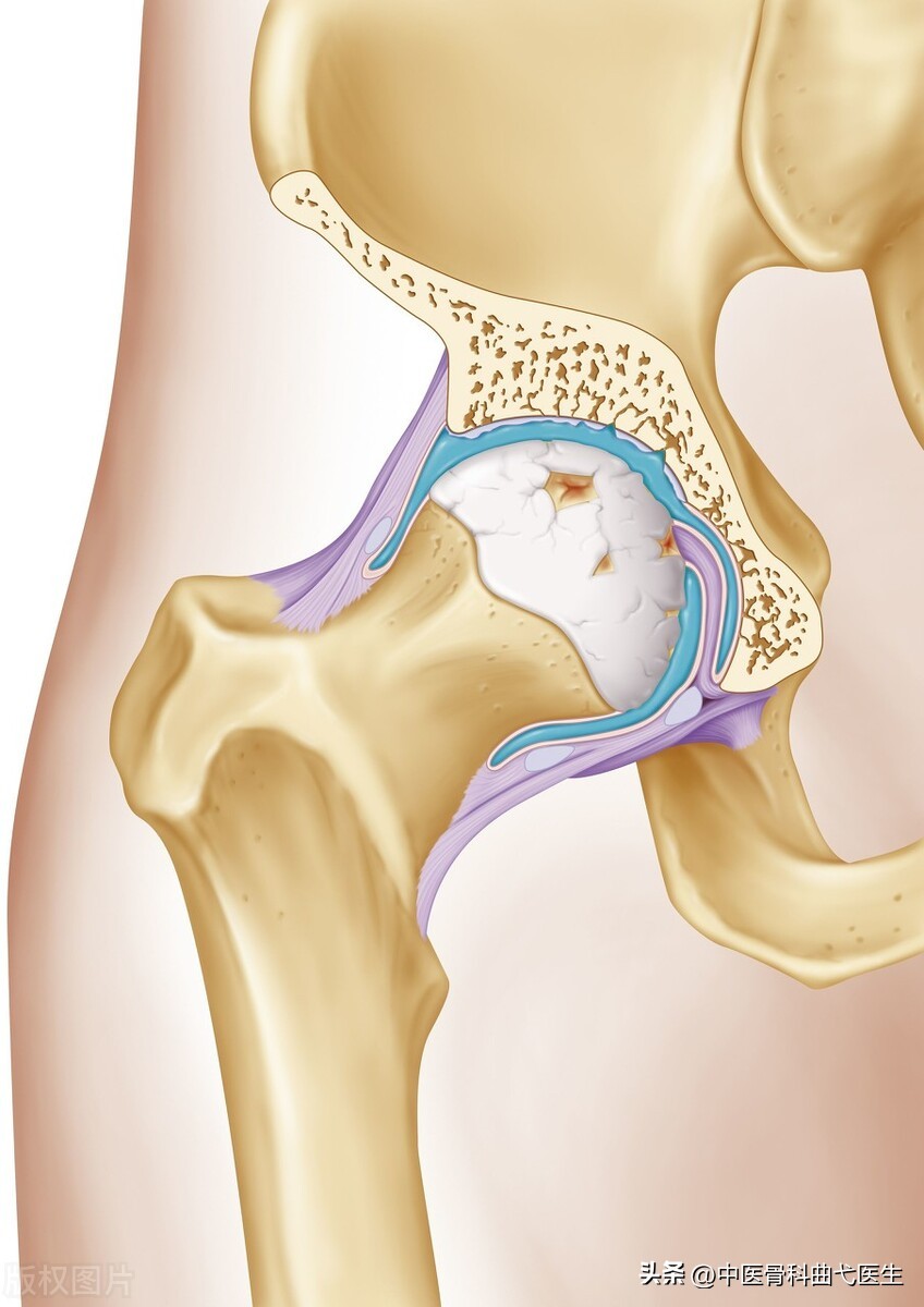 股骨头坏死早期症状花多少钱,髋关节股骨头坏死的早期症状