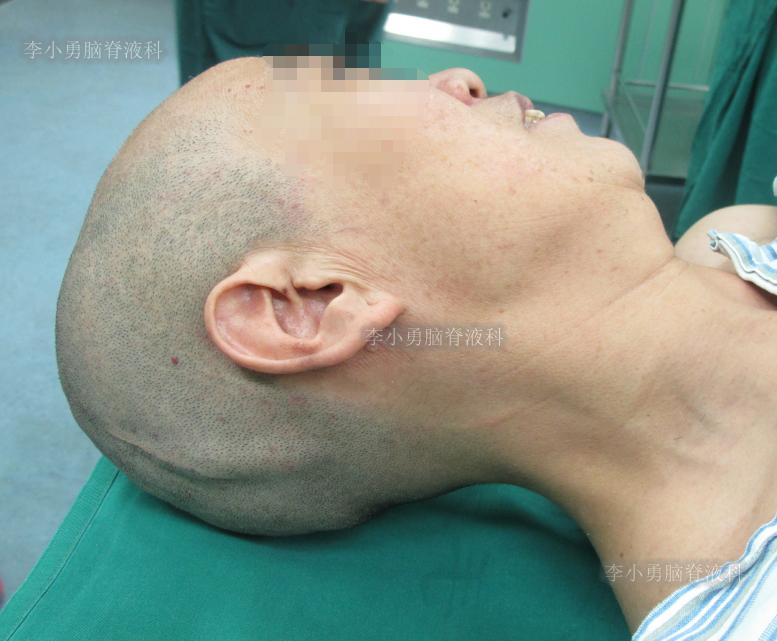 脑积水手术后4天还呕吐怎么回事,脑积水分流术后一直腹部疼痛