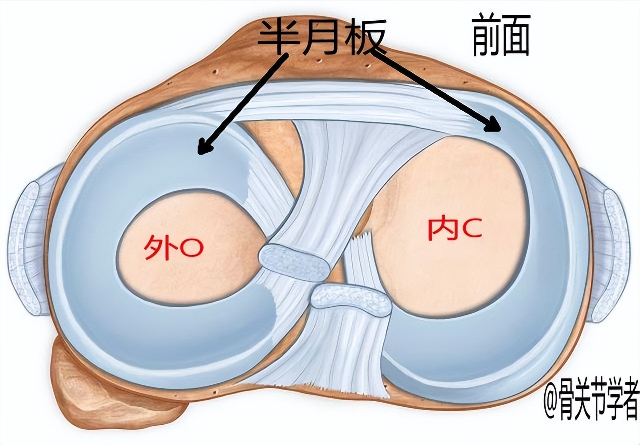半月板损伤严重的状态是什么,半月板损伤应该注意什么问题
