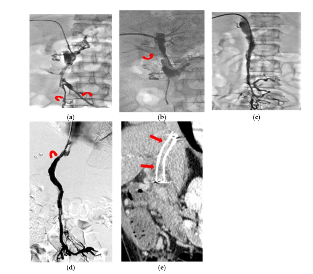 非肝硬化门静脉血栓,门静脉血栓溶栓治疗