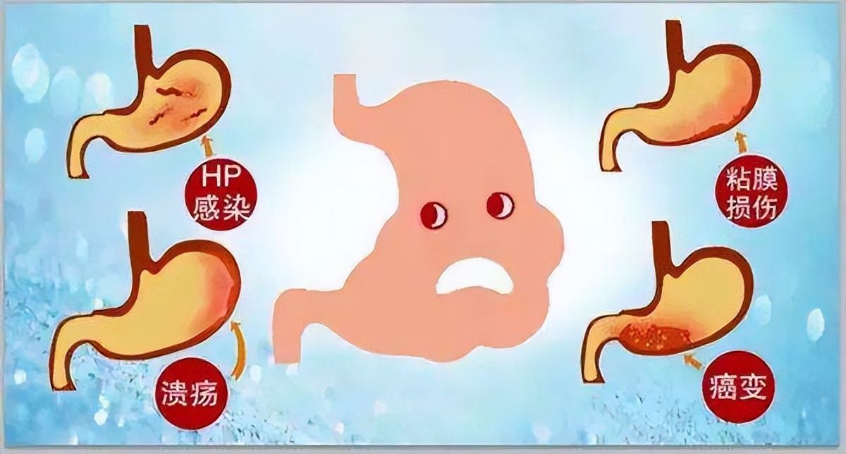 炎症到癌症一般多久,专家说长期炎症可能会拖成癌症