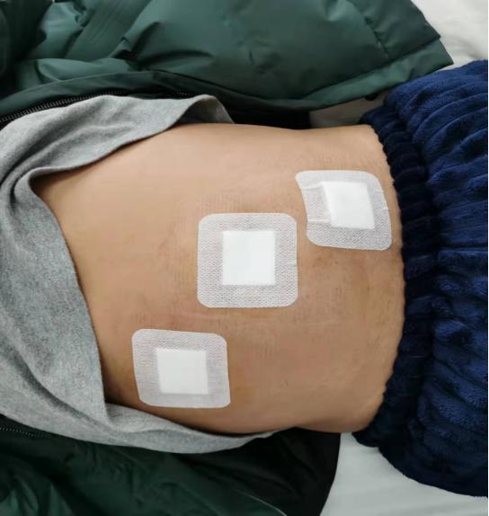 腹腔镜疝气手术多久可出院,腹腔镜微创疝气手术后20天了