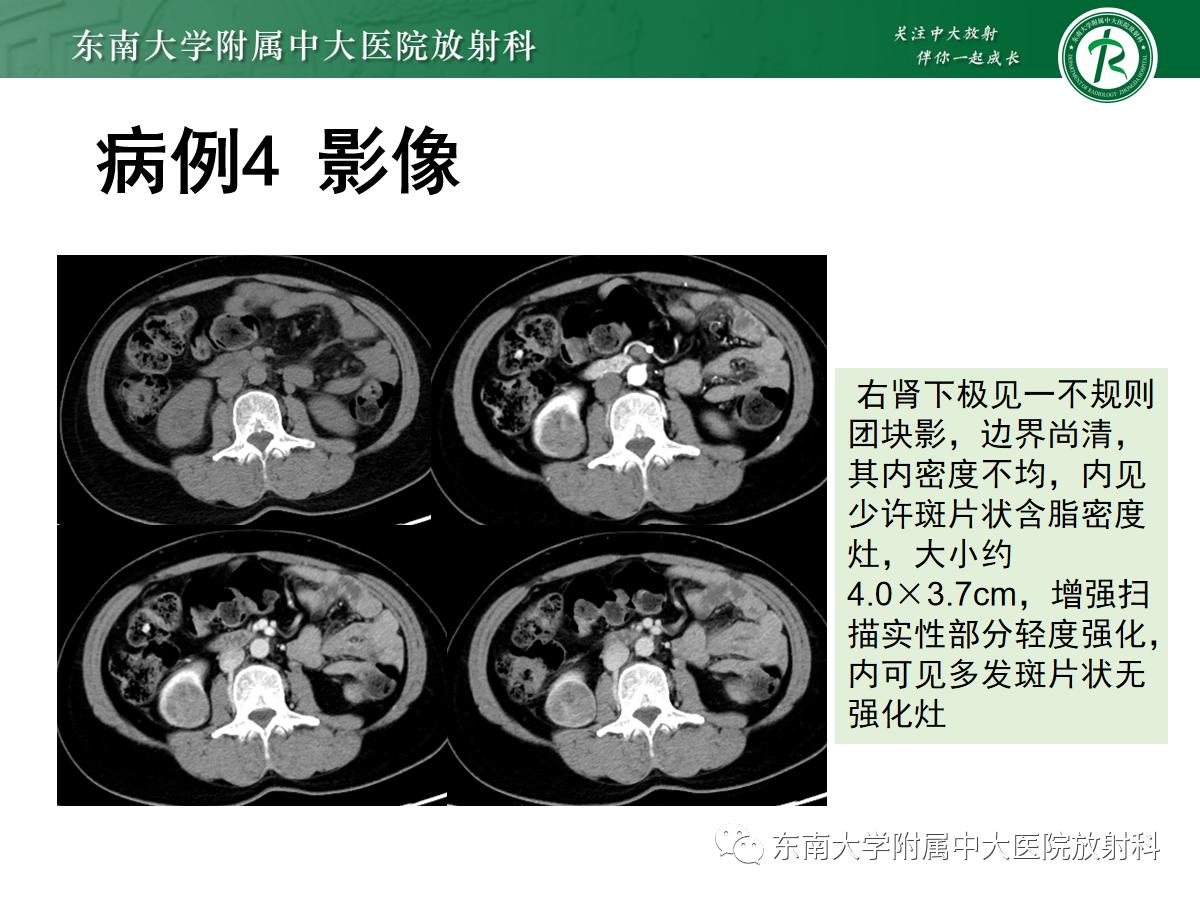 周利群谈肾嫌色细胞癌ct特点,好文分享值得深思