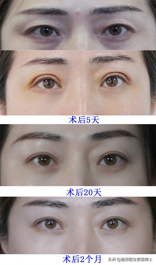 三角眼眼皮松弛怎么做好看,45岁上眼皮松弛下垂出现三角眼