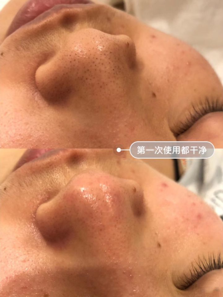 超微小气泡美容有用吗,美容院小气泡