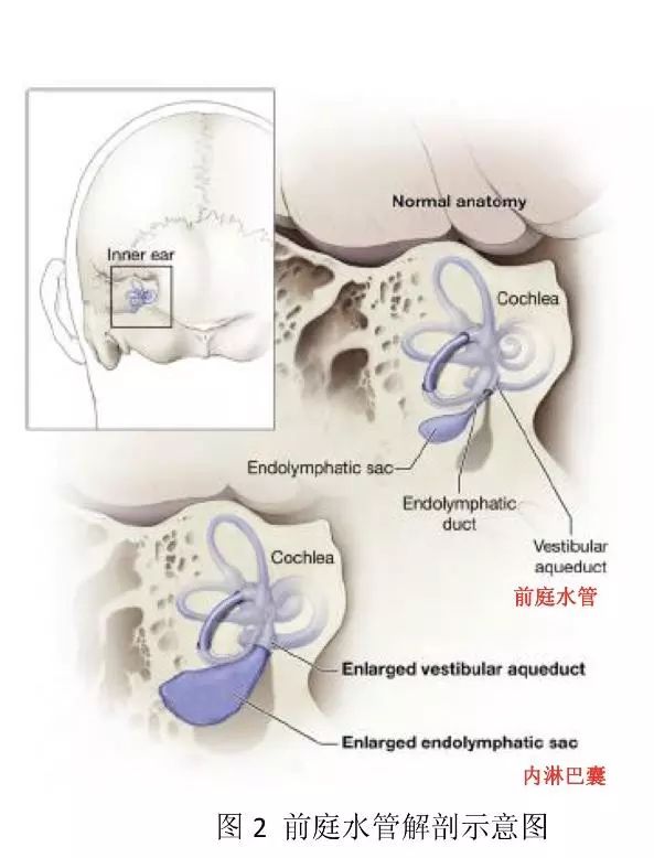 大前庭导水管正常值,大前庭导水管结构