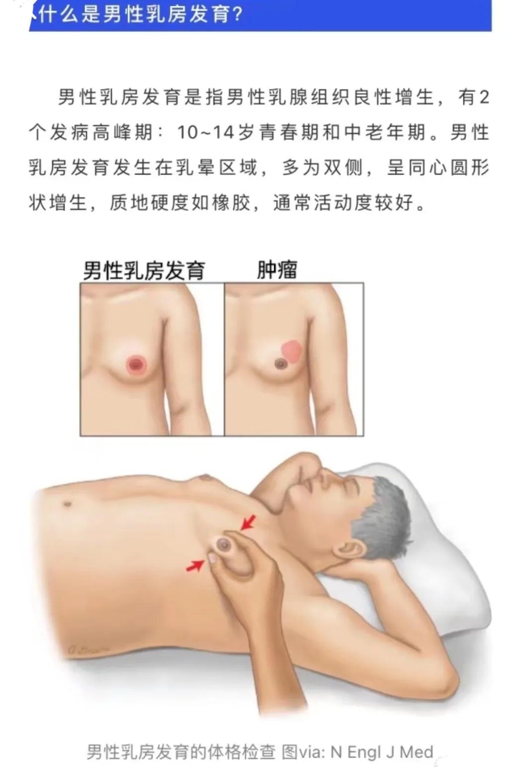 乳腺增生跟有没有男朋友有关系吗,男生乳腺增生可以通过锻炼治愈吗