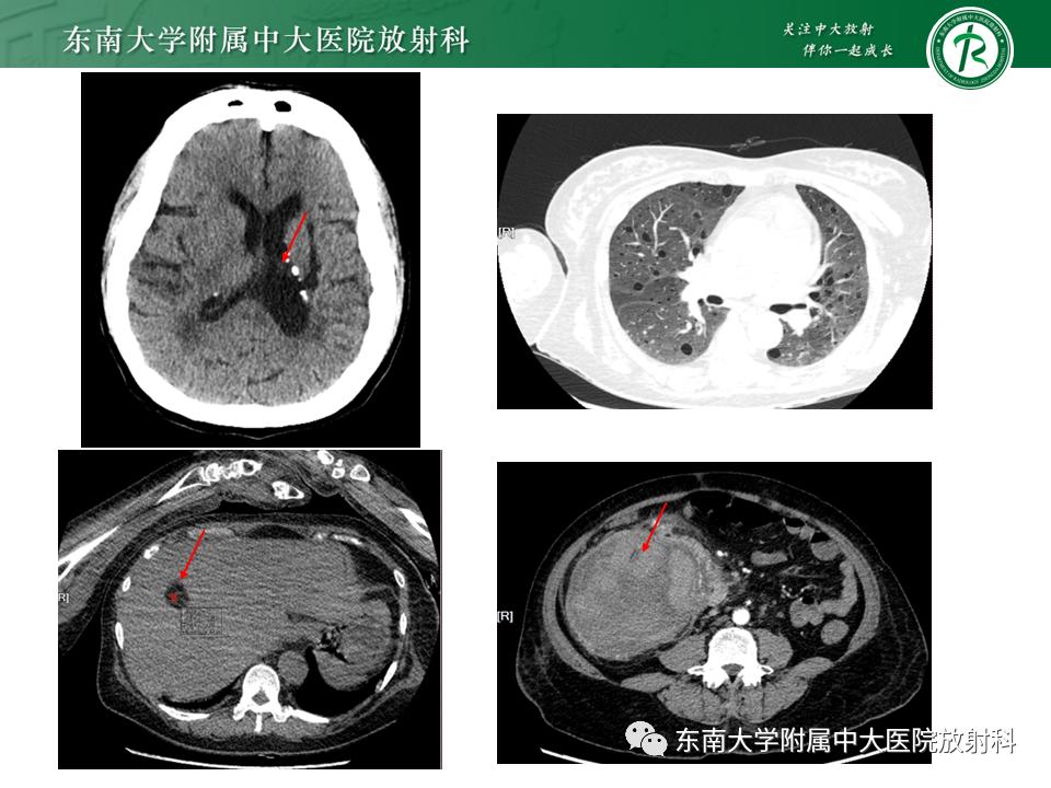好文分享——《肾血管平滑肌脂肪瘤》