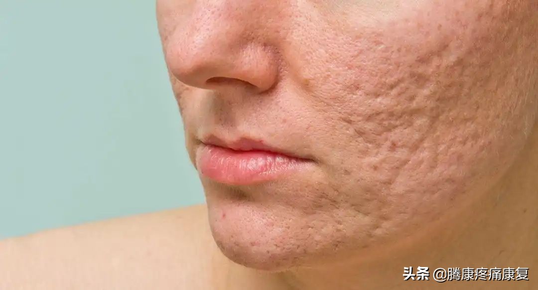 疮疗的后遗症怎么治疗,痤疮留下的瘢痕疙瘩