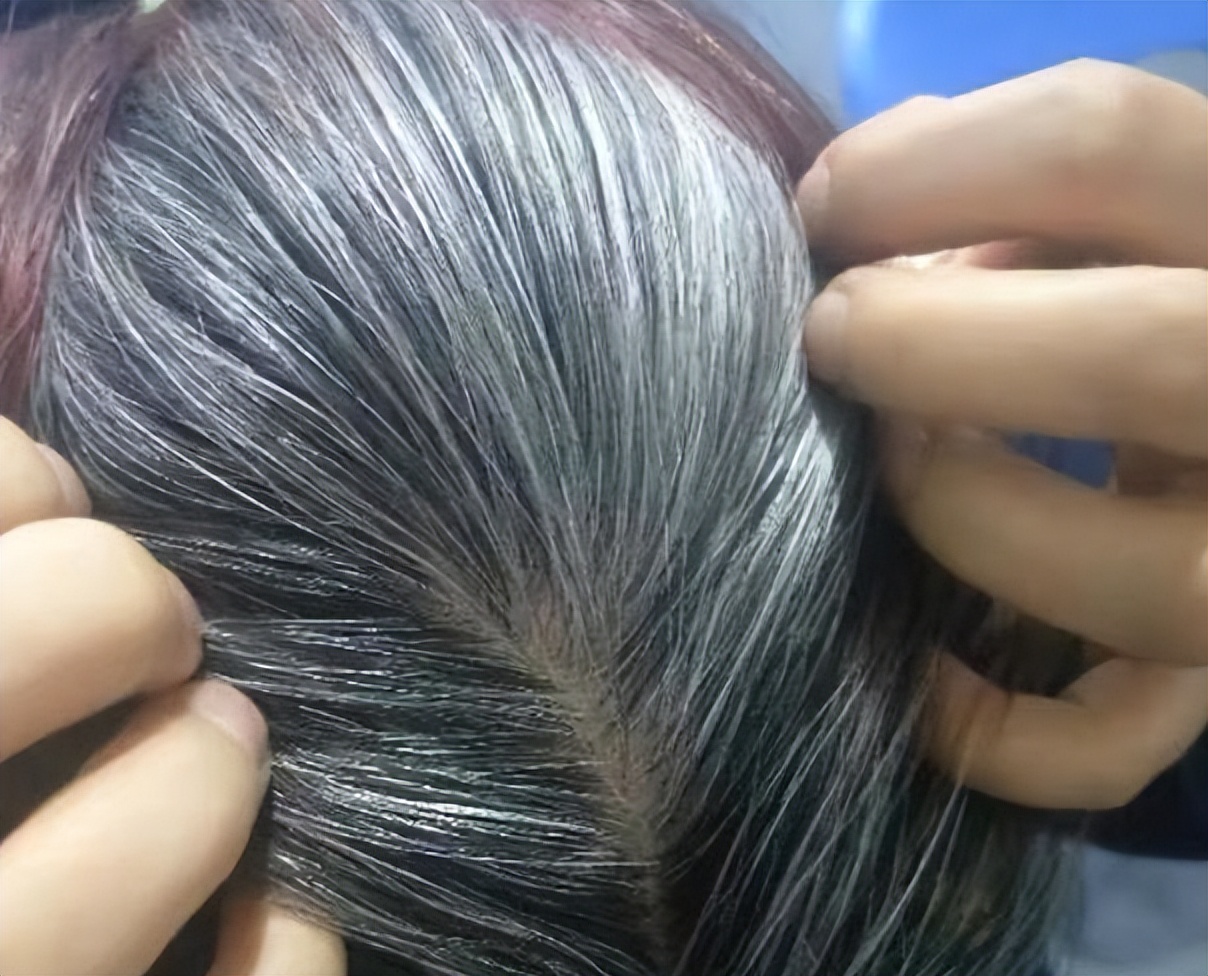 为什么白头发营养不足还一直长,白头发越来越多缺少什么营养