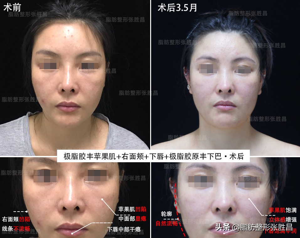 自体脂肪填充丰胸缺点,自身脂肪填充脸部有什么缺点