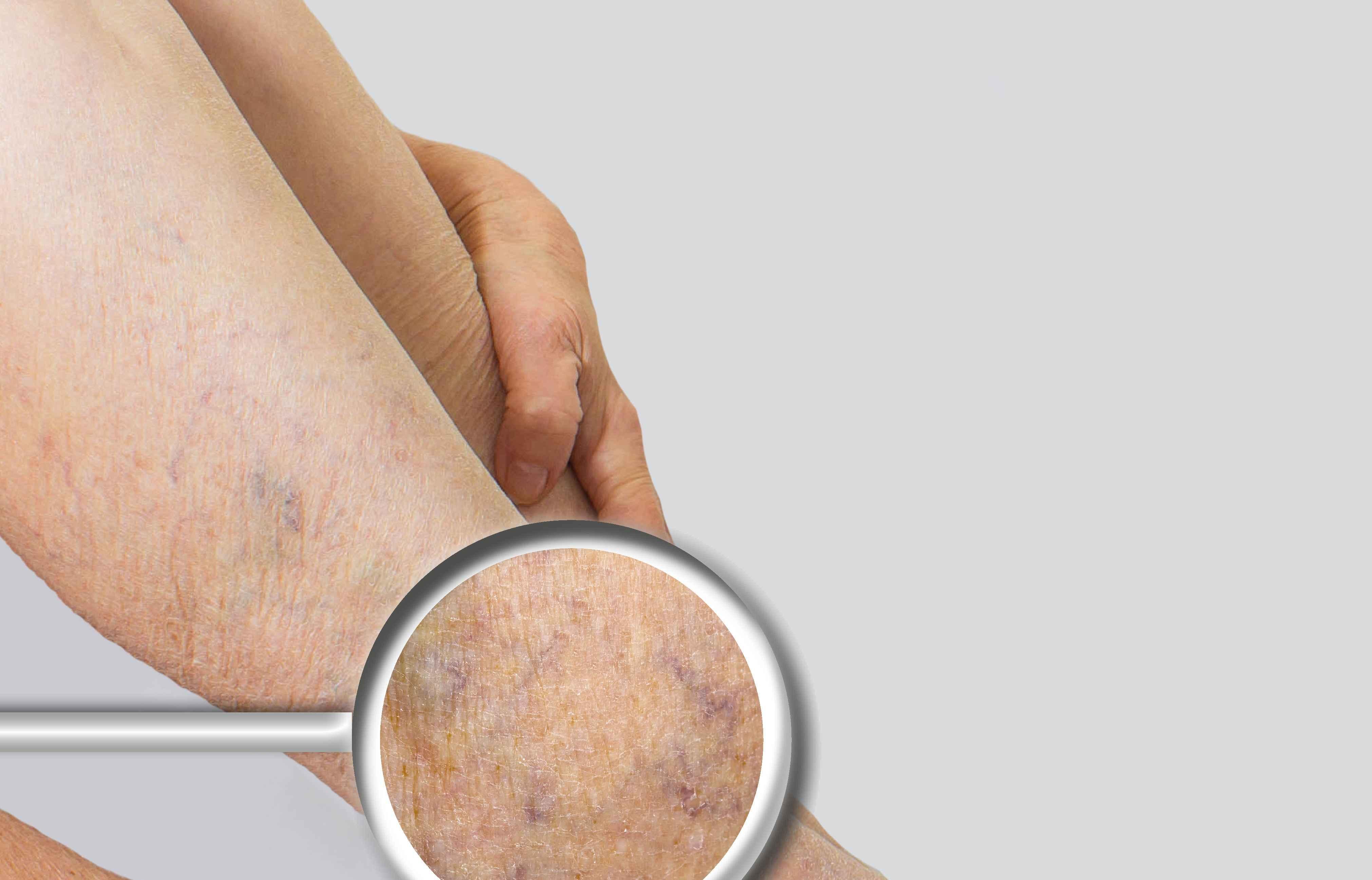 腿酸胀痛麻木可能是疾病的征兆,腿发麻是怎么回事要注意什么