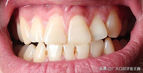 牙齿老是发黄有牙渍怎么办,牙齿里面根部黄渍去除小妙招