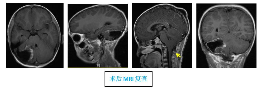7岁脑瘤患儿转运至广州救治直播,治愈后的脑肿瘤儿童